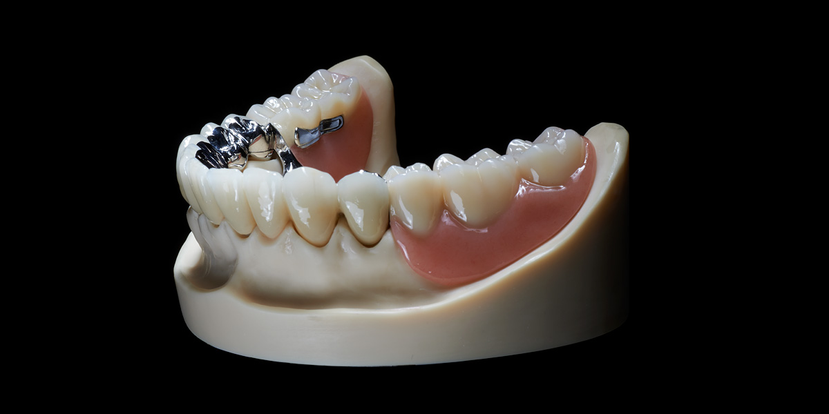 Zirkon vollverblendet