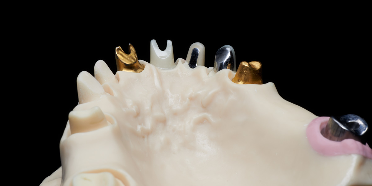 Teleskopprothese NEM