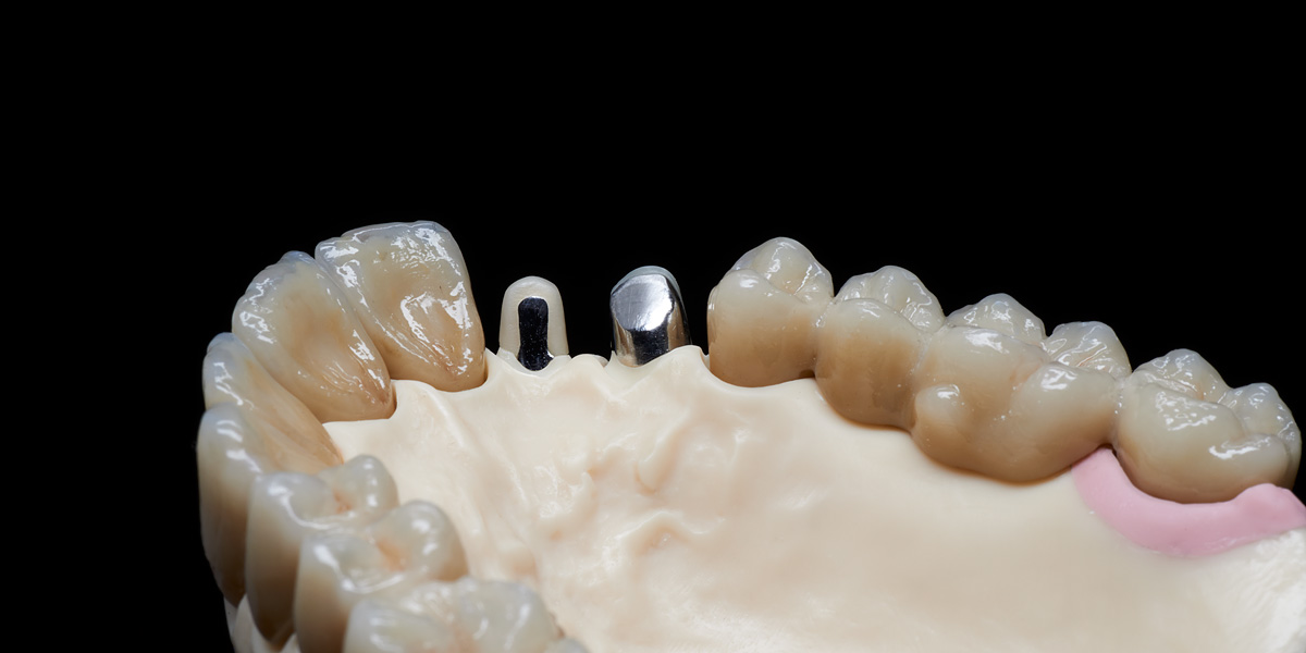 Implantat-Hybridbrücke