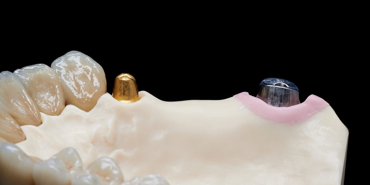 Zirkonkrone monolithisch