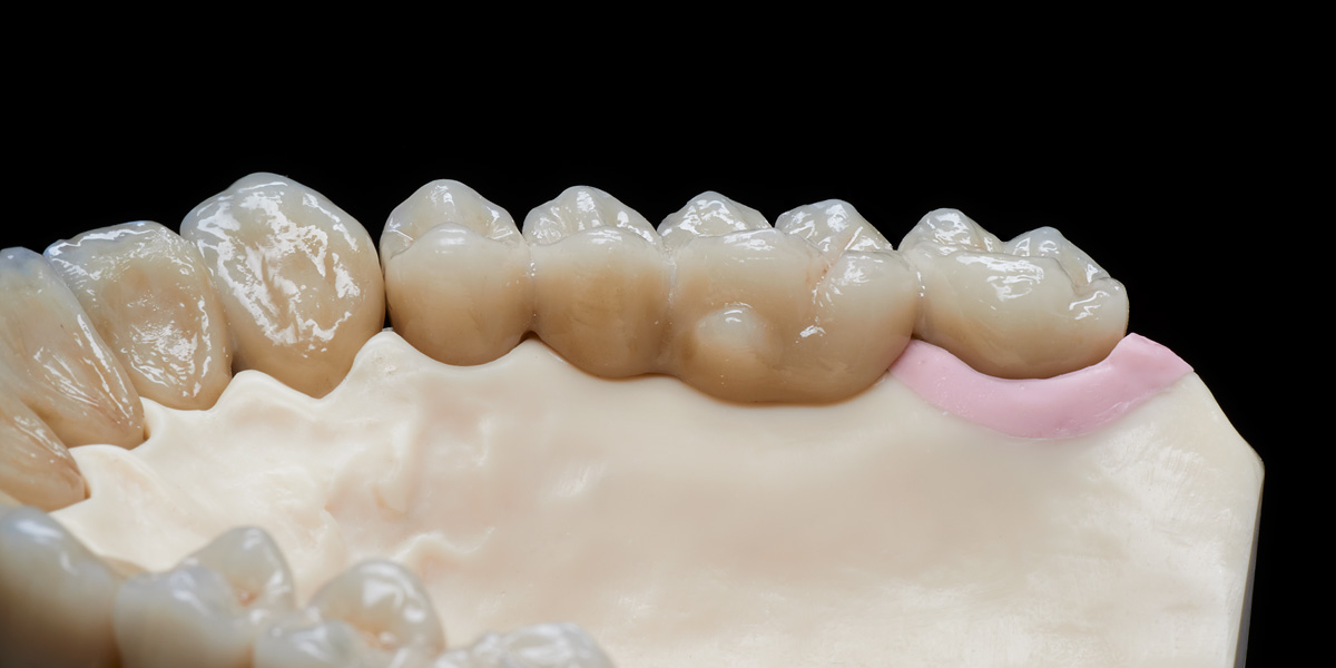 Kombinationsarbeit Prothese