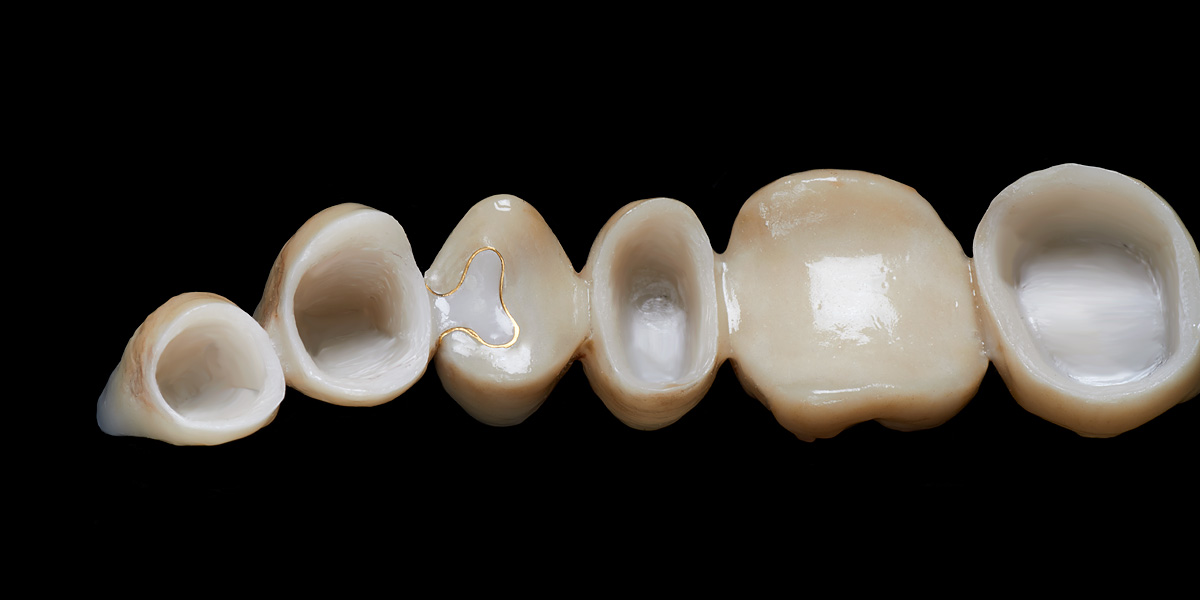 Implantatgetragene Brücke