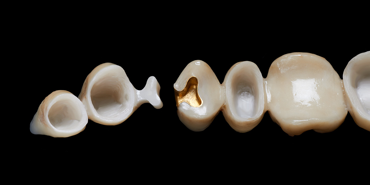 Vollkeramische Brücke