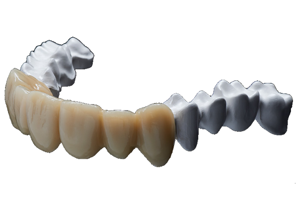 PEEK Teleskopprothese