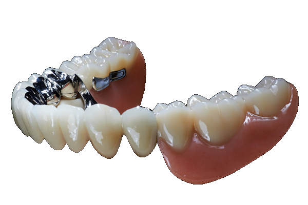 Riegelarbeiten Geschiebeprothetik